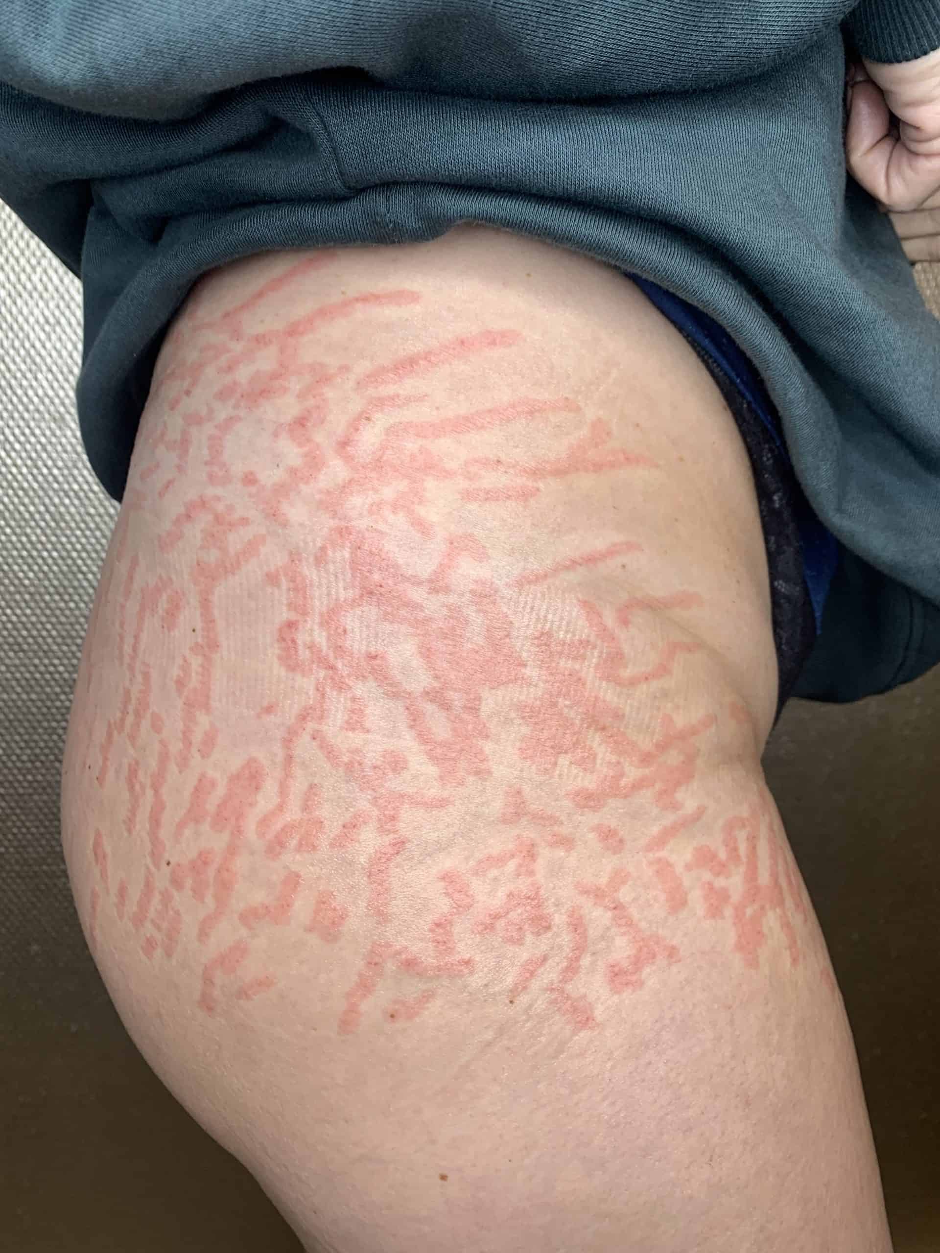 Striae behandeling - dijbeen direct na de behandeling