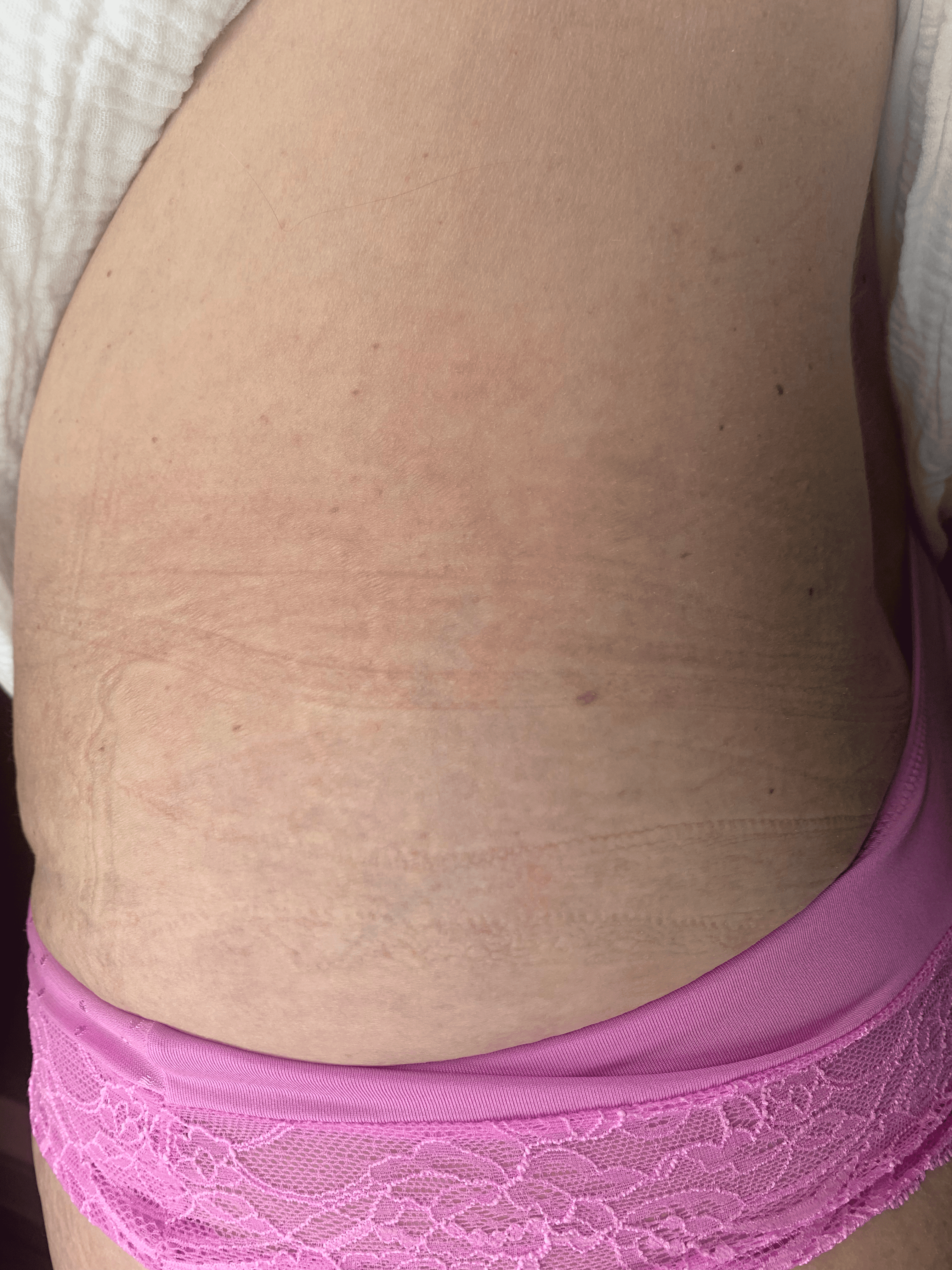 Striae heup na de eerste behandeling
