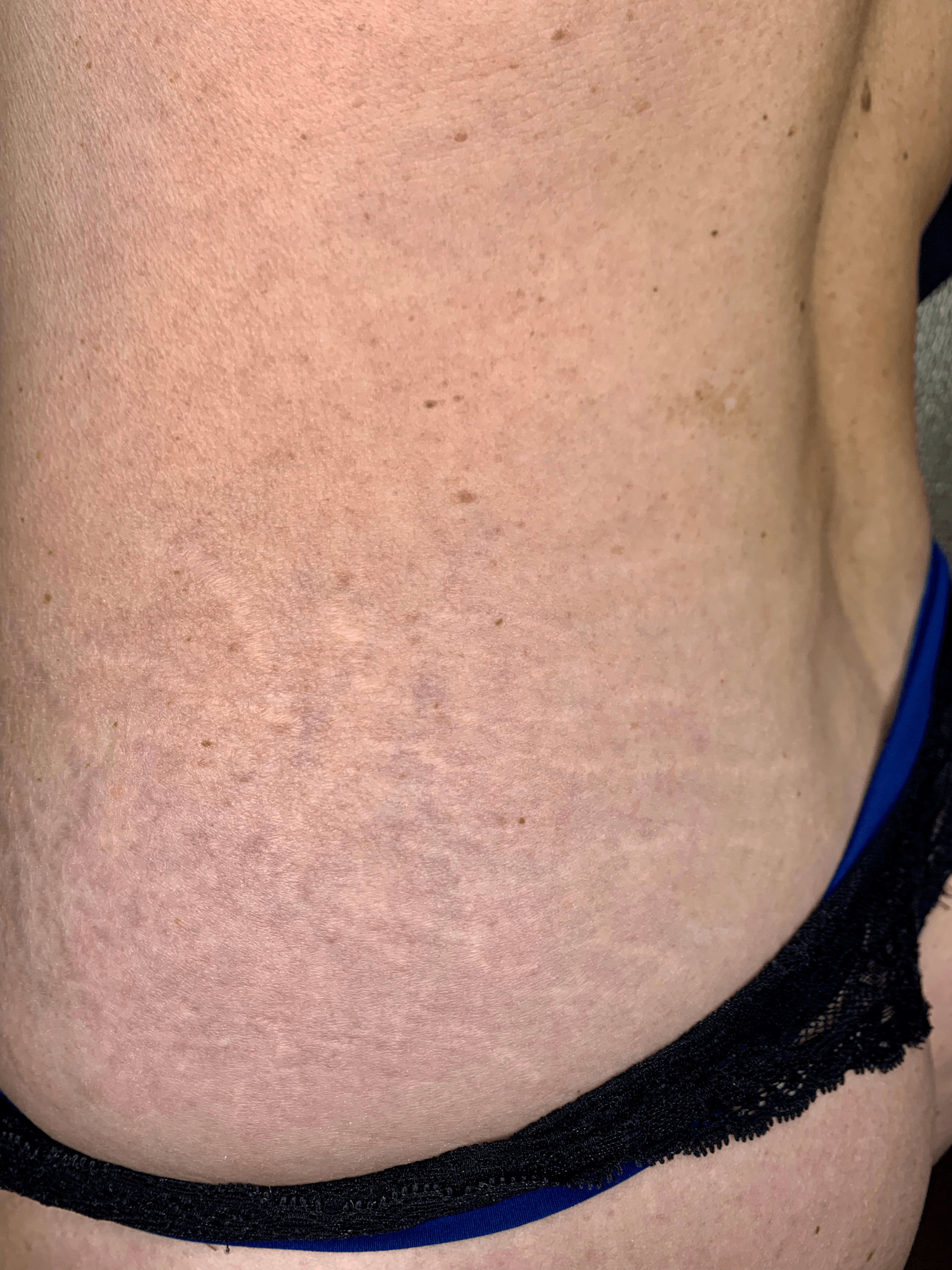 Striae behandeling - Striae heup voor de eerste behandeling