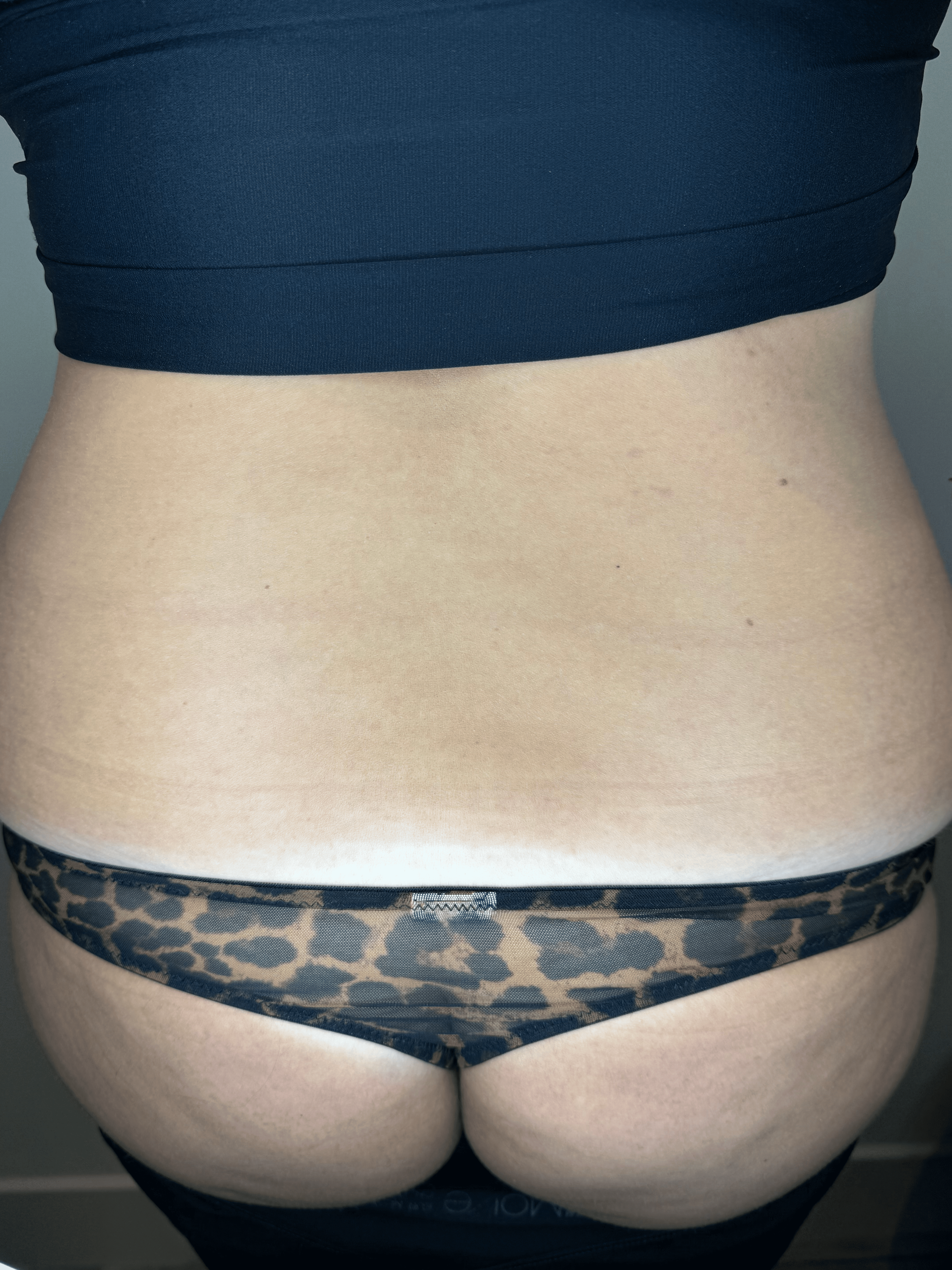 Striae onderrug na 2 behandelingen