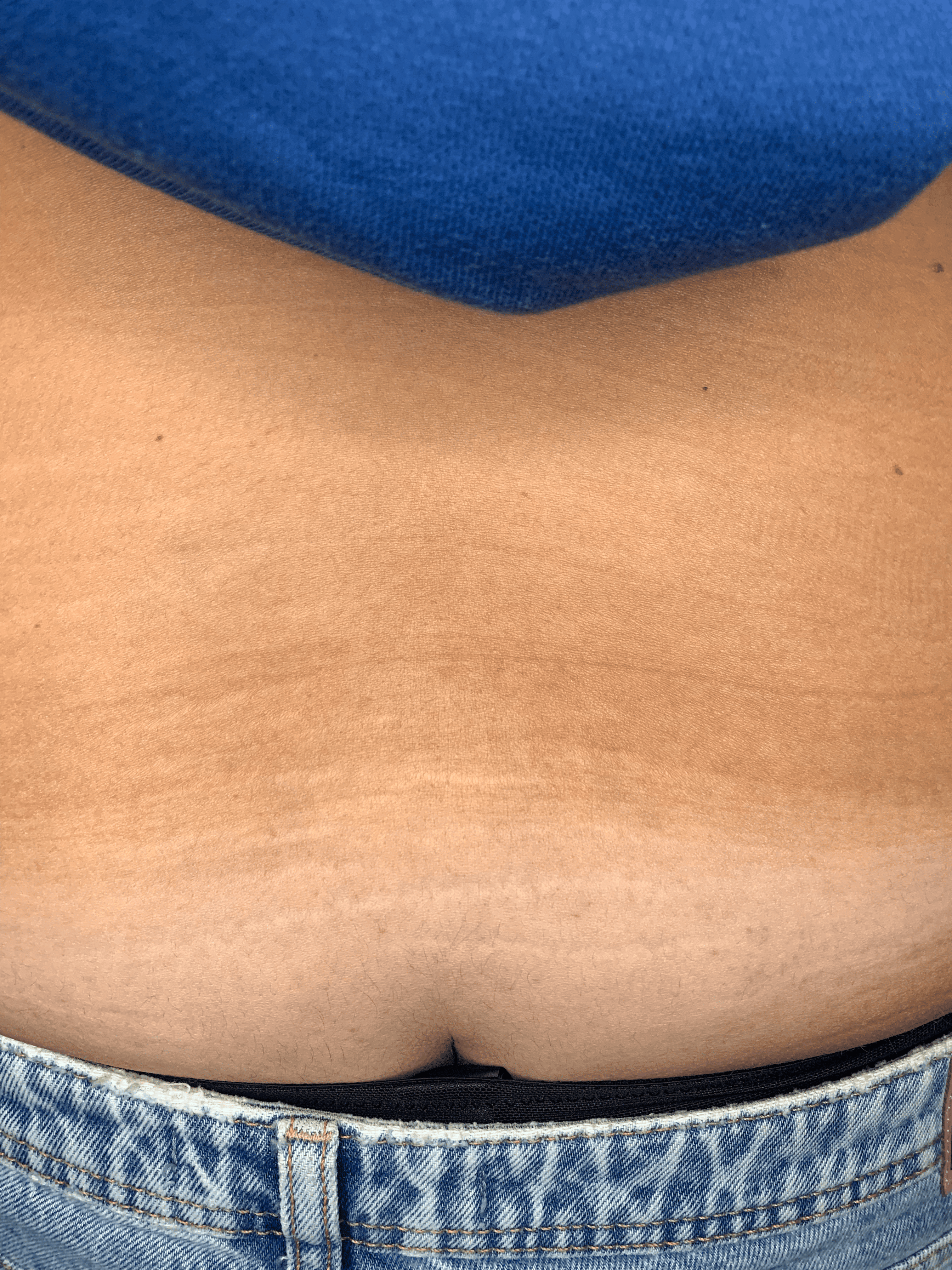 Striae onderrug voor de eerste behandeling