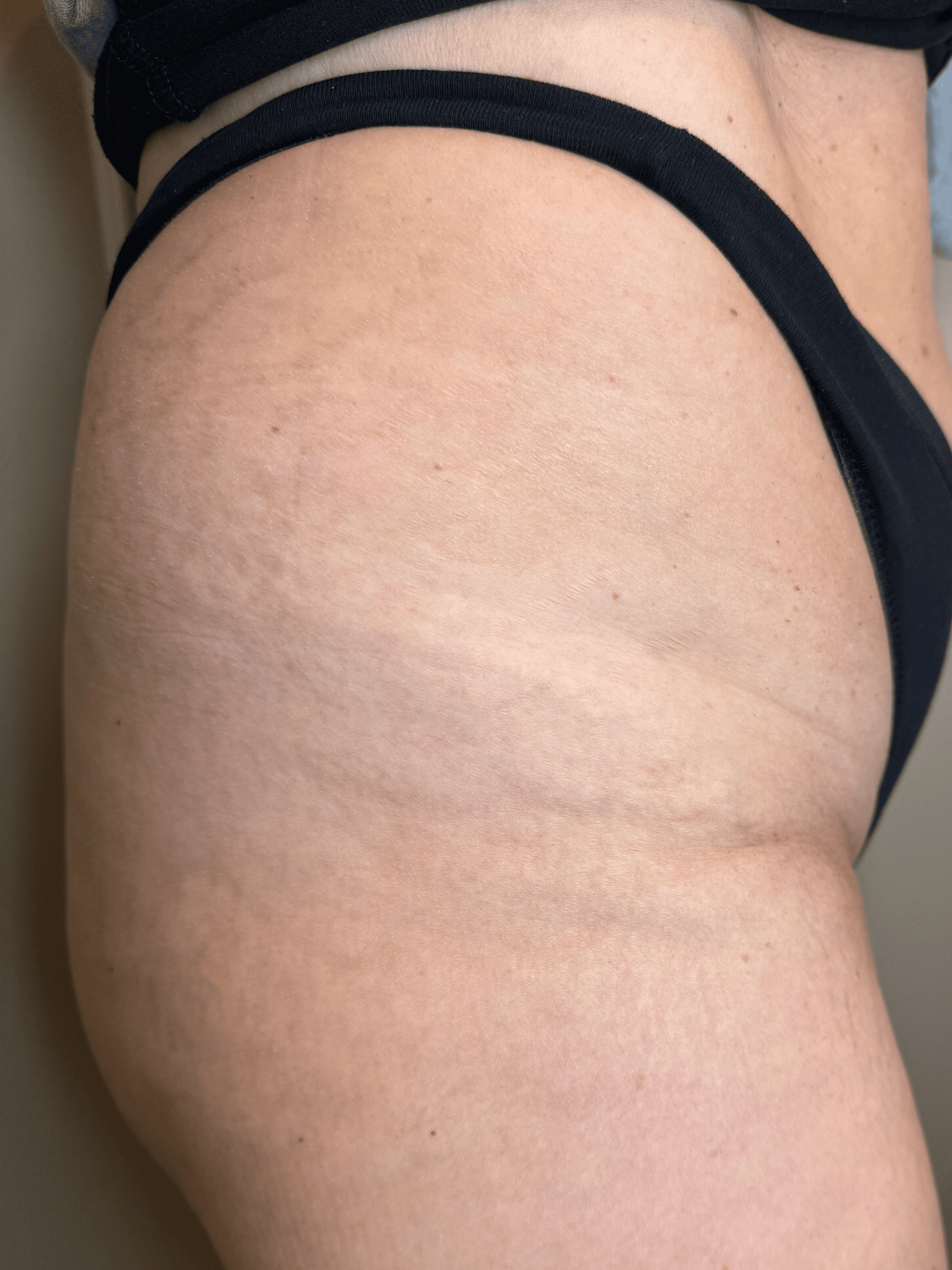 Striae behandeling - Striae op dijbeen na 1 behandeling