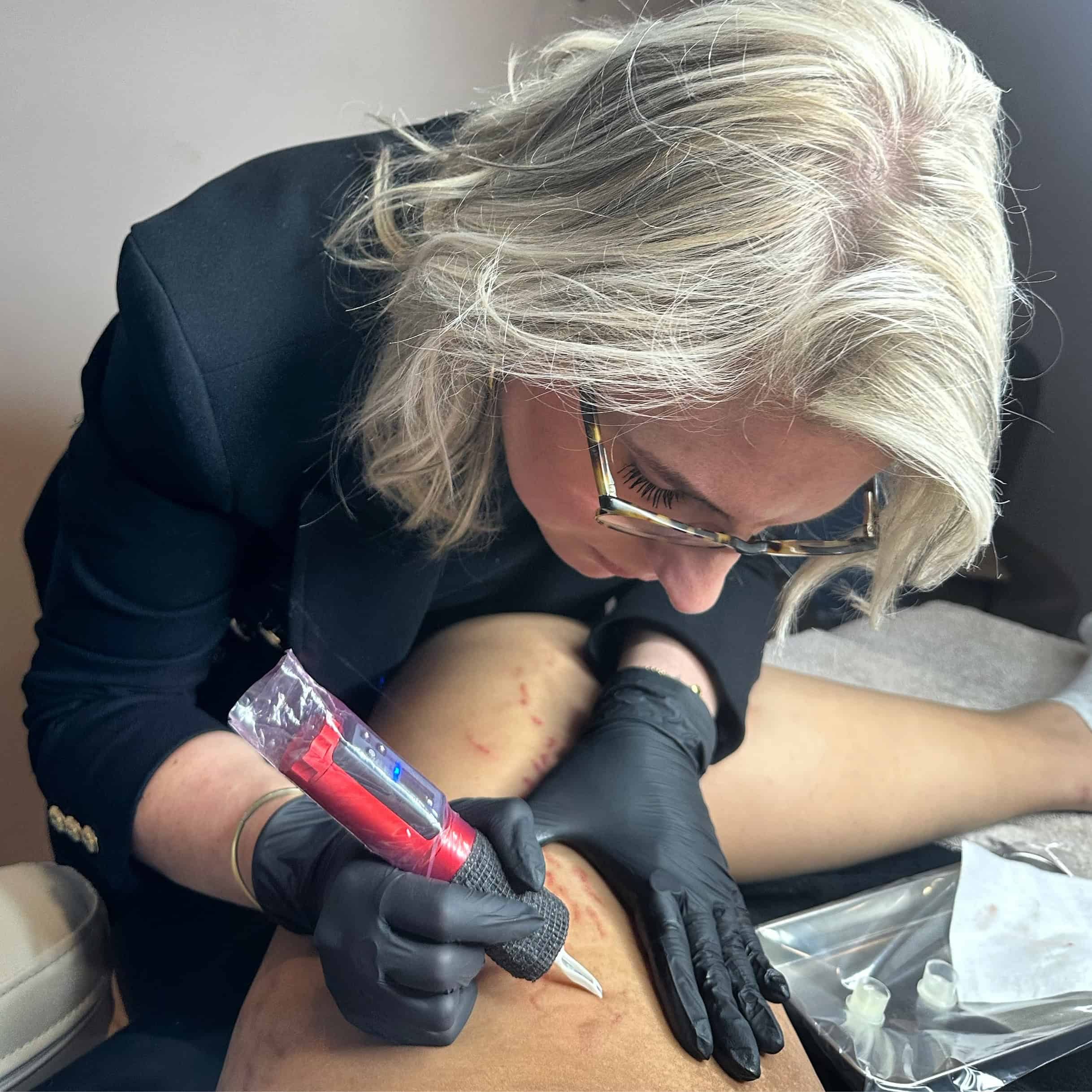 Striae_1 Scar removal By Rosch