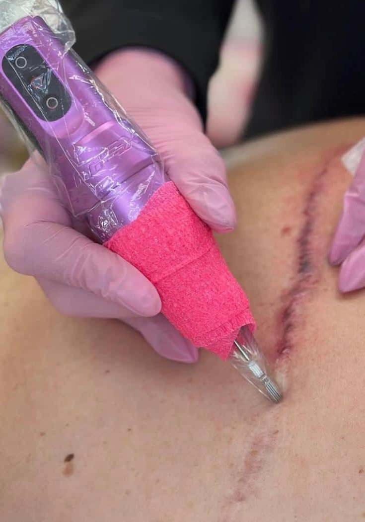 Litteken verwijderen Litteken behandeling