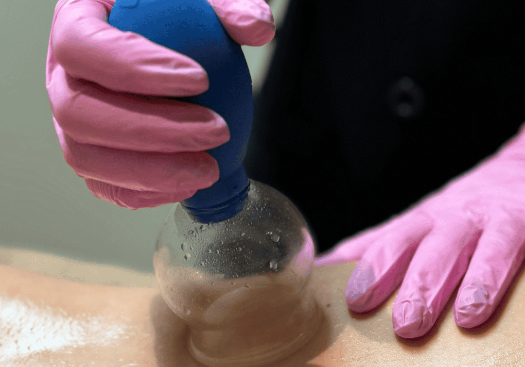 Cuppen Boost jouw lichaam met cupping